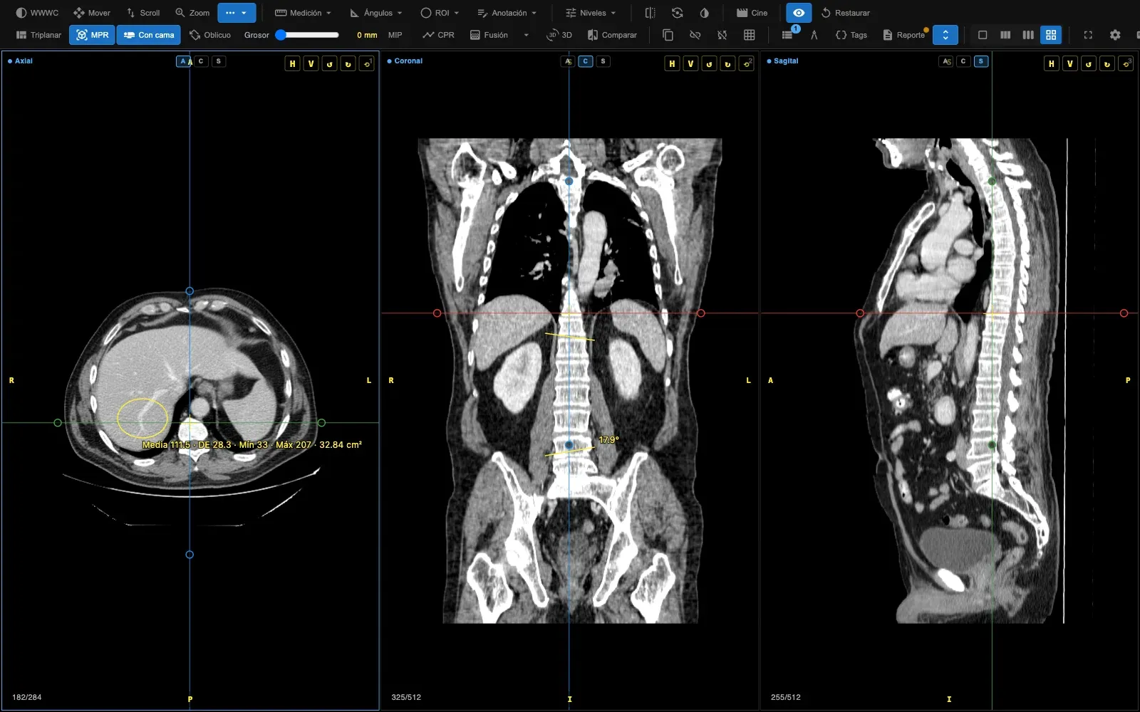 Mediciones sobre el MPR: un ROI elíptico en el hígado del corte axial con media, desviación estándar, mínimo, máximo y área, y un ángulo de Cobb trazado sobre la columna en el plano coronal