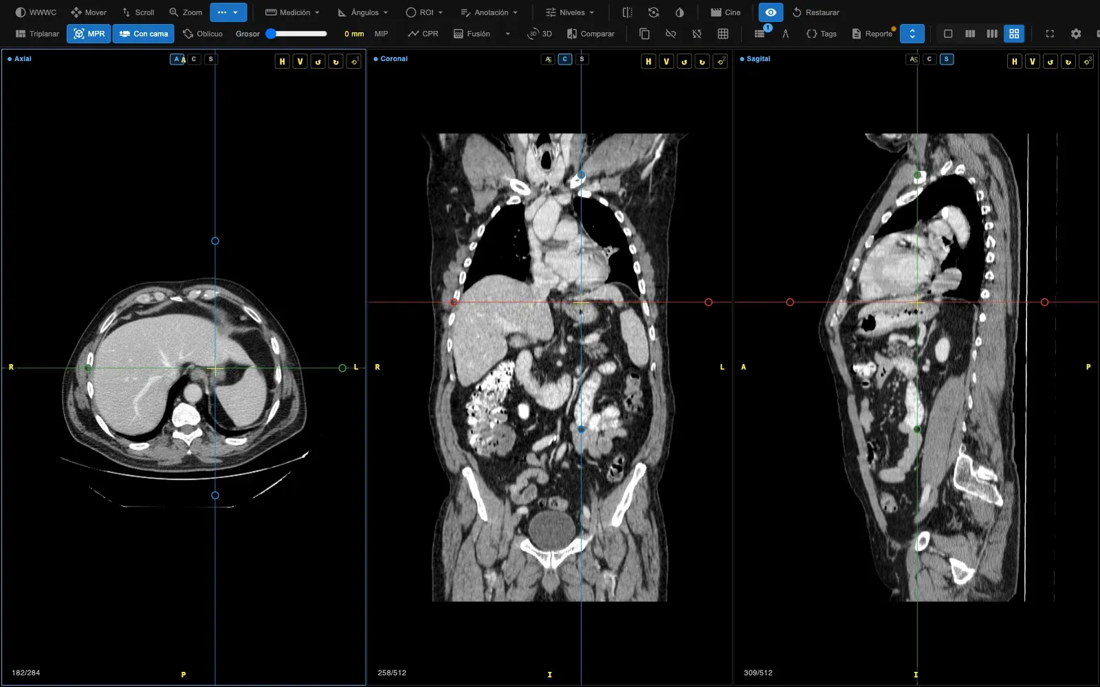 MPR de una tomografía toracoabdominal en tres columnas: axial, coronal y sagital, con la mira y las líneas de referencia de cada plano dibujadas sobre los otros